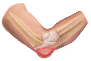 Elbow Bursitis Treatment